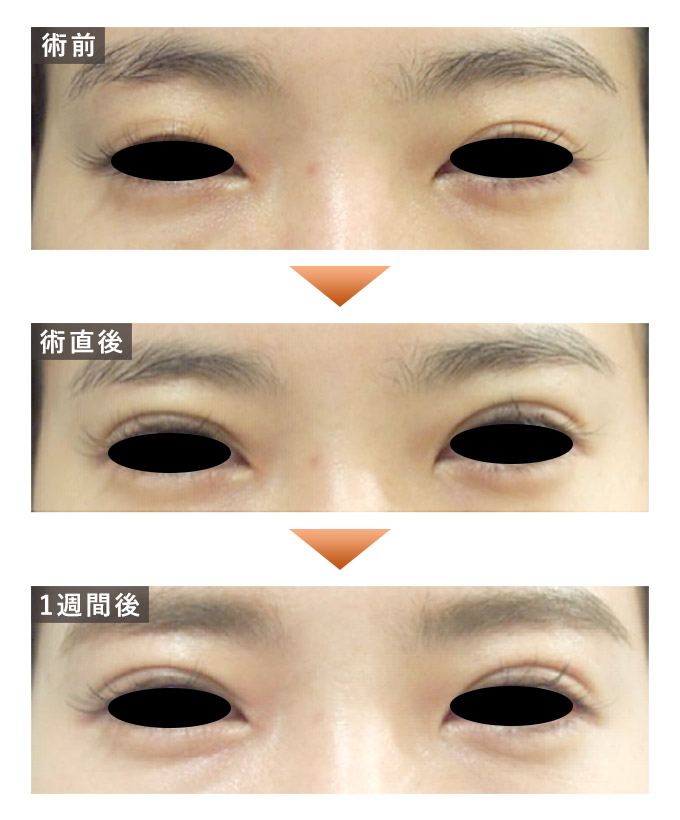 埋没法