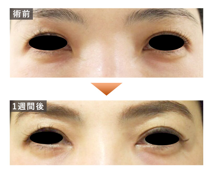 目頭切開