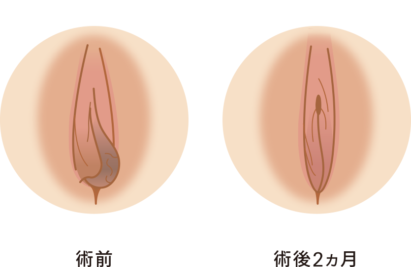 小陰唇縮小症例写真