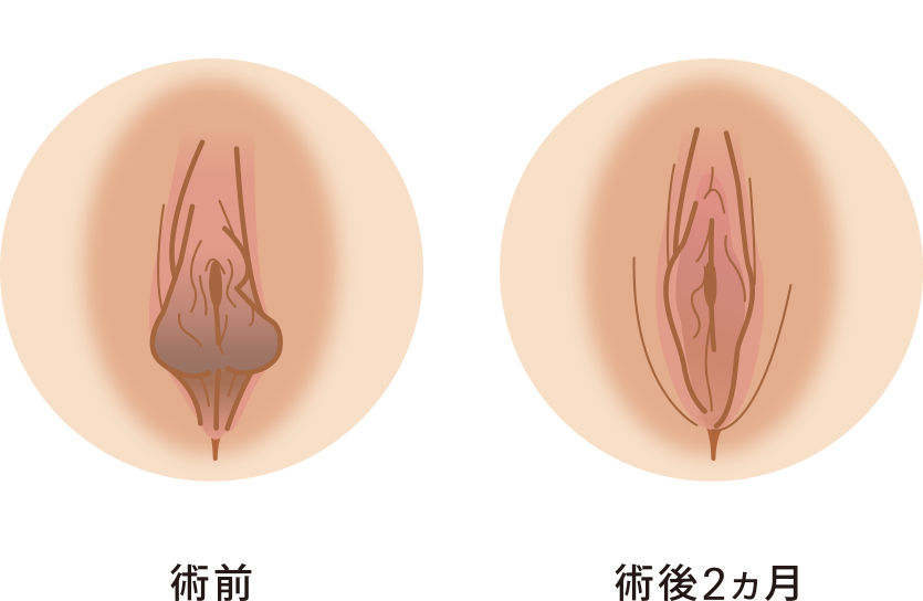 小陰唇縮小症例写真