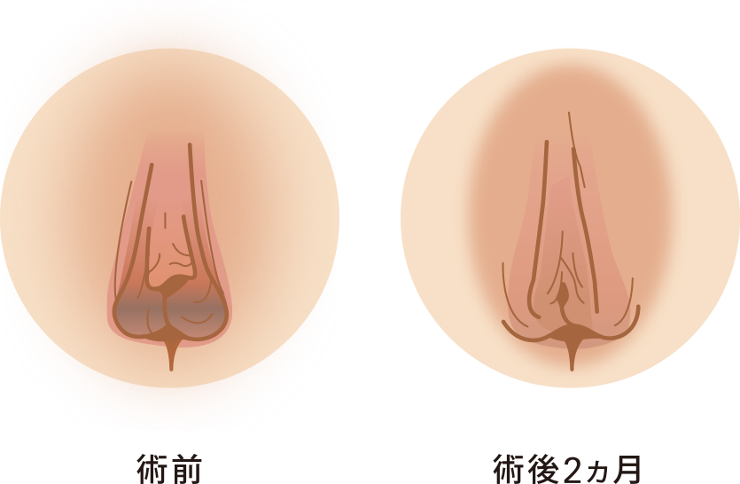 小陰唇縮小症例写真