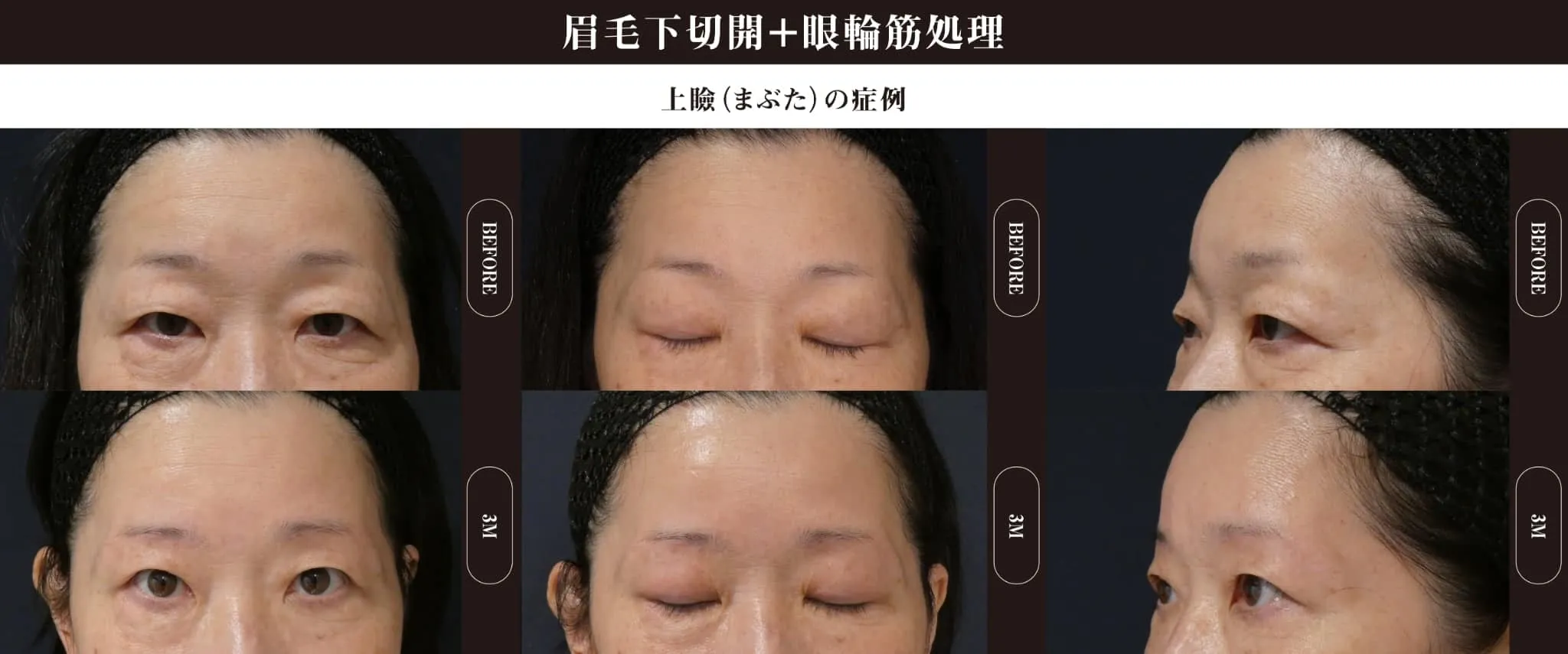 眉毛下切開(上眼瞼リフト)のビフォー・アフター症例その１ | 施術前と術後の正面経過観察(PC版)