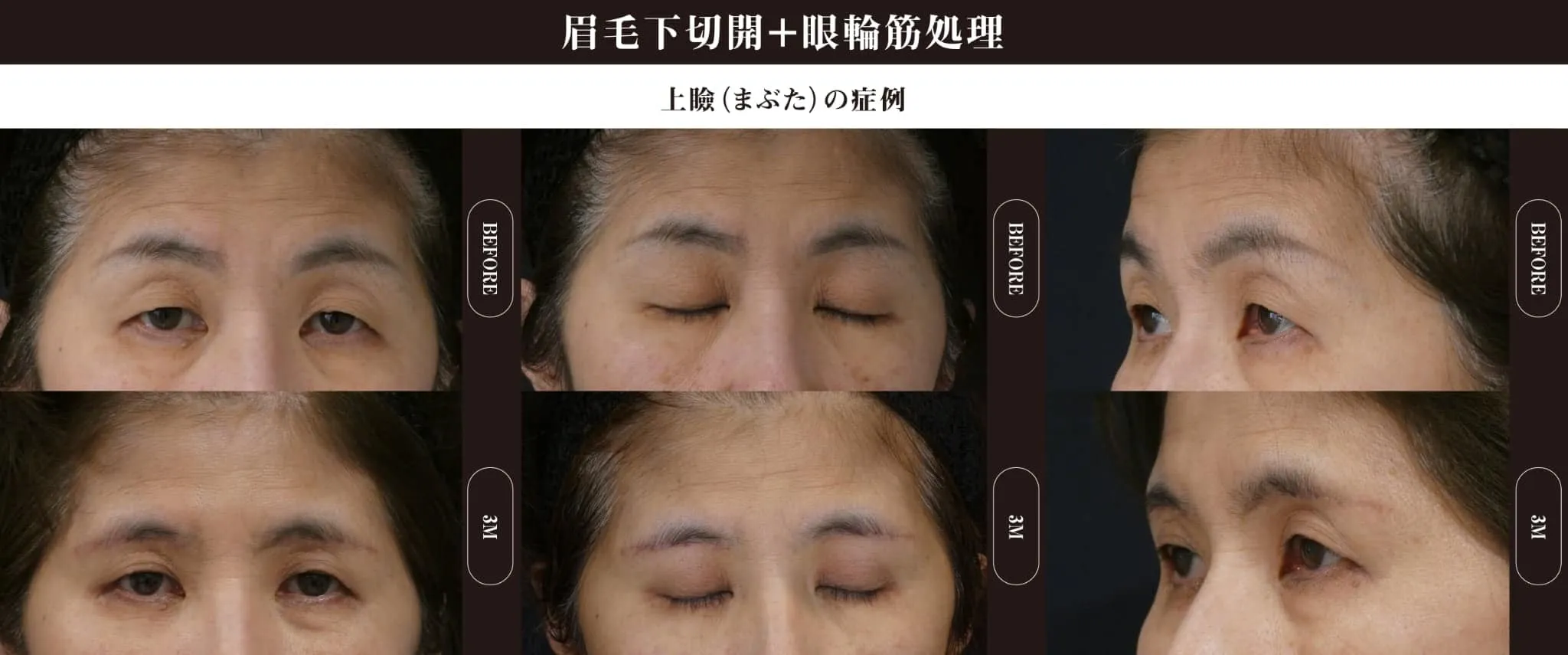 眉毛下切開(上眼瞼リフト)のビフォー・アフター症例その１ | 施術前と術後の正面経過観察(PC版)
