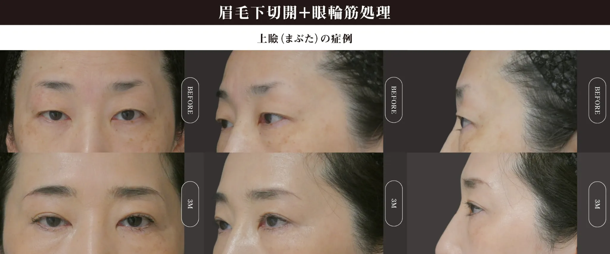 眉毛下切開(上眼瞼リフト)のビフォー・アフター症例その１ | 施術前と術後の正面経過観察(PC版)