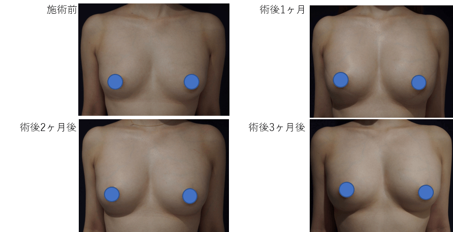 コンデンスリッチ豊胸のビフォー・アフター症例その1 | 施術前から1ヶ月後、2ヶ月後、3ヶ月後の経過観察(PC版)