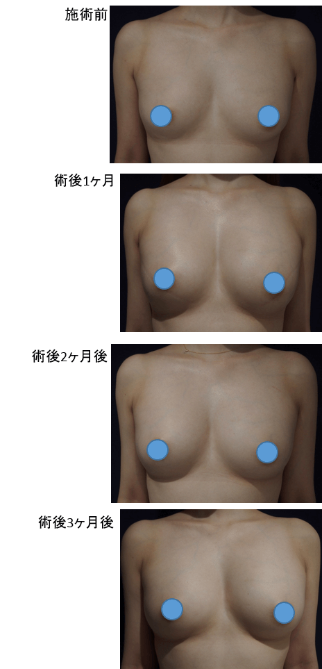 コンデンスリッチ豊胸のビフォー・アフター症例その1 | 施術前から1ヶ月後、2ヶ月後、3ヶ月後の経過観察(SP版)