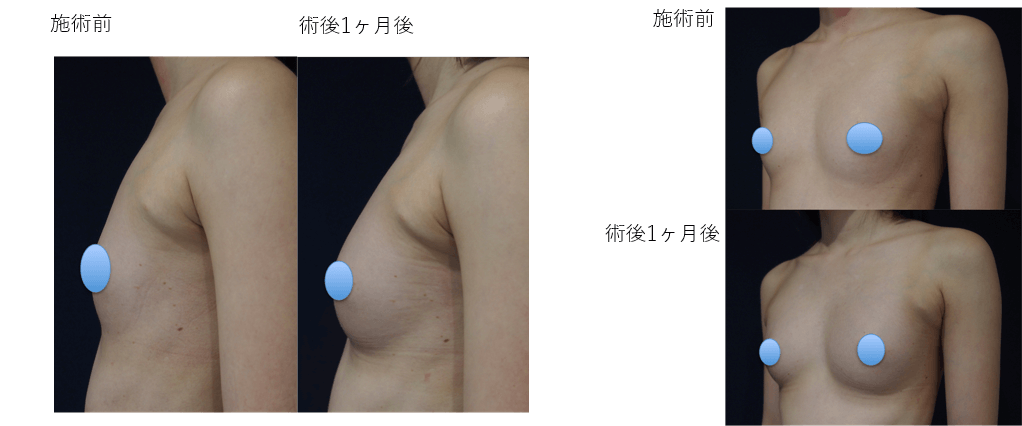 コンデンスリッチ豊胸のビフォー・アフター症例その2 | 施術前から1ヶ月後の経過観察(PC版)
