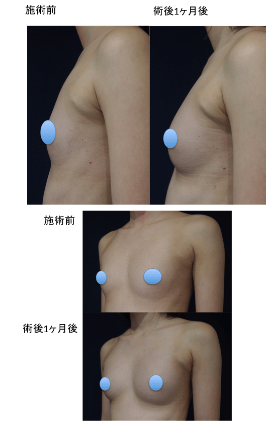 コンデンスリッチ豊胸のビフォー・アフター症例その2 | 施術前から1ヶ月後の経過観察(SP版)