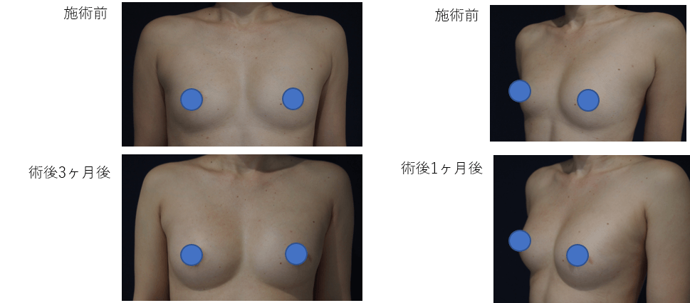 コンデンスリッチ豊胸のビフォー・アフター症例その3 | 施術前から1ヶ月後、3ヶ月後の経過観察(PC版)