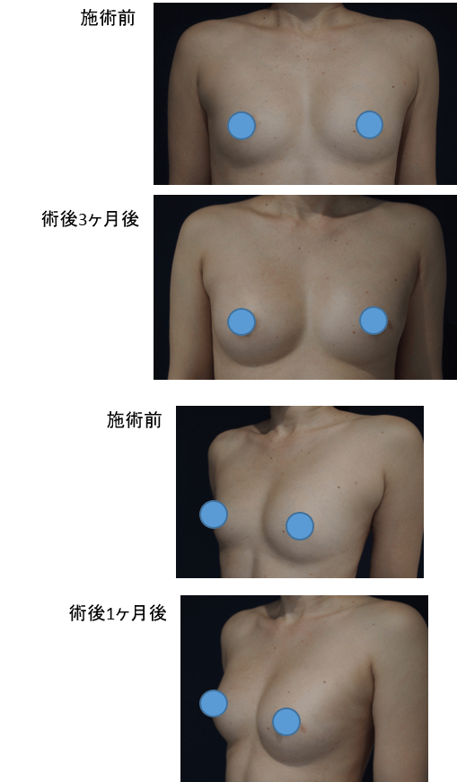 コンデンスリッチ豊胸のビフォー・アフター症例その3 | 施術前から1ヶ月後、3ヶ月後の経過観察(SP版)