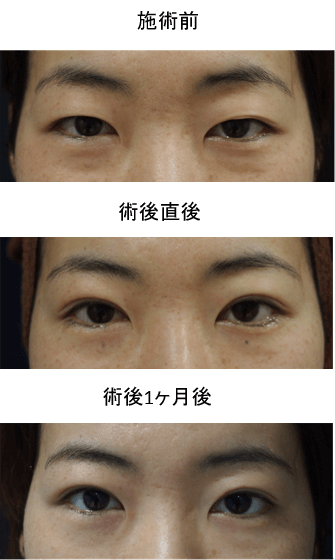 両目3点止めエターナルメソッド