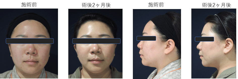 フェイスラインすっきりプラン