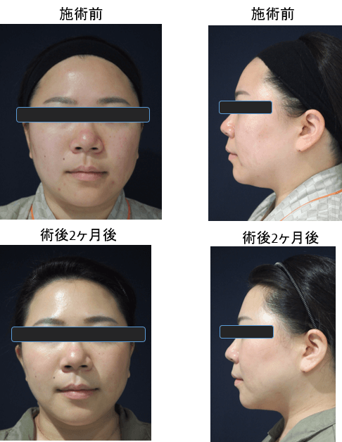 フェイスラインすっきりプラン