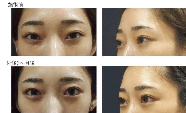 目尻切開+目尻靭帯移動+グラマラスライン形成(経結膜)