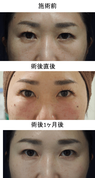目の下脂肪注入