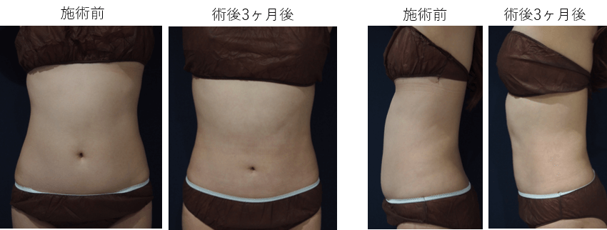 ウェストくびれ形成セット