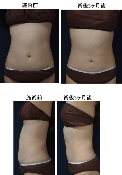 ウェストくびれ形成セット